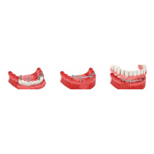  Complete removable denture on a bar basis with MULTI UNIT attachment