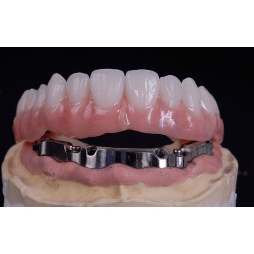 Implant-supported removable denture